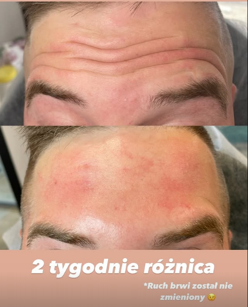 Ботокс, токсин ботулінічний — ефект до і після, Прущ Гданський 1