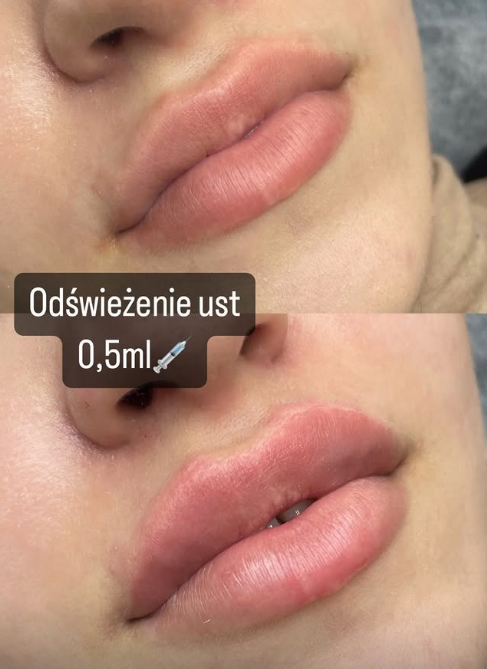 Збільшення губ гіалуроновою кислотою — ефект до і після, Прущ Гданський 3