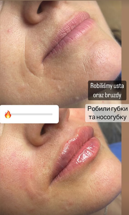 Збільшення губ гіалуроновою кислотою — ефект до і після, Прущ Гданський 6