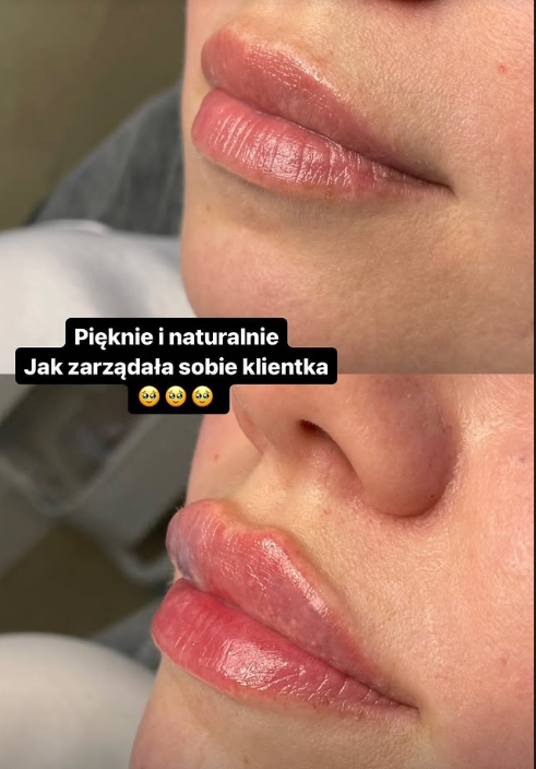 Збільшення губ гіалуроновою кислотою — ефект до і після, Прущ Гданський 8